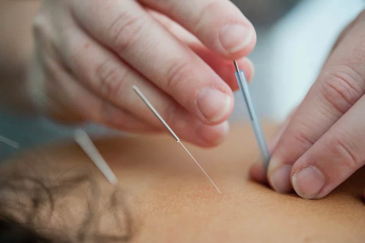 London acupuncturist performing a treatment session in a calm clinic environment with professional needle placement